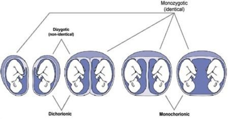 Types of twins.jpg